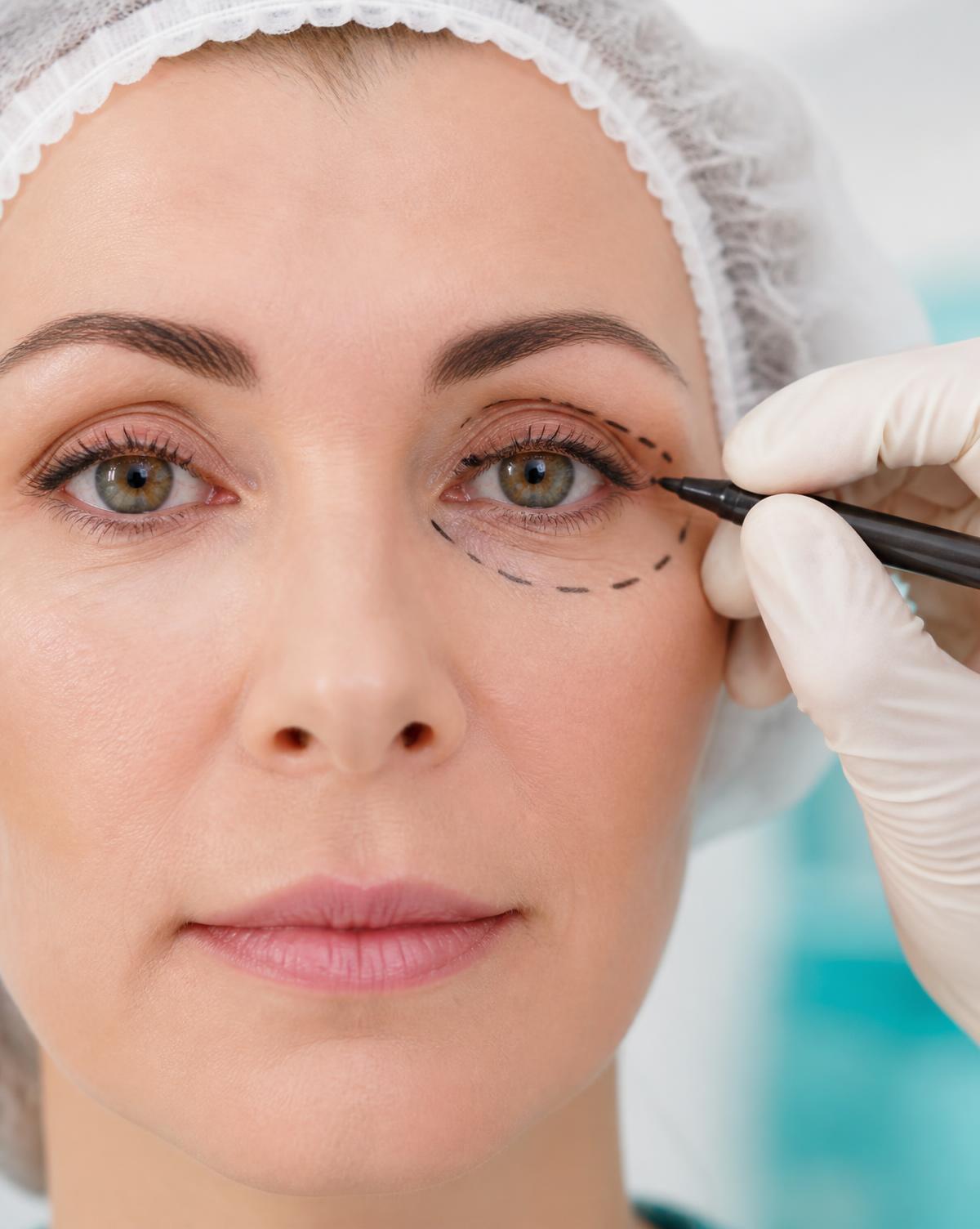 Blefaroplastia